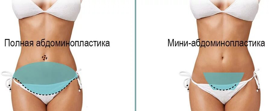 разновидности абдоминопластики миниабдоминопластика и классическая абдоминопластика