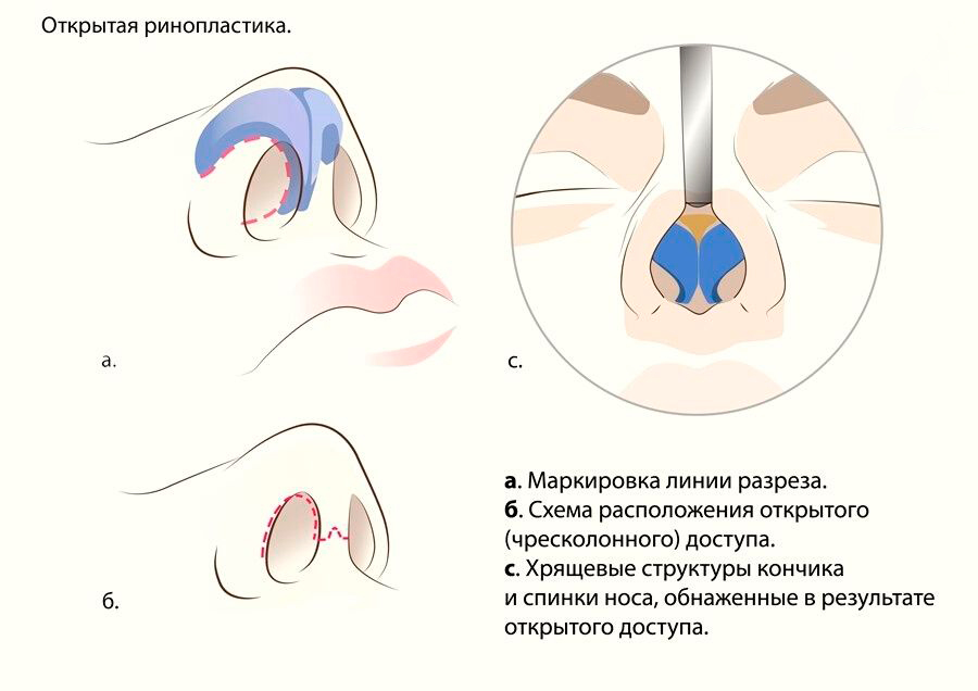 доступ при открытой ринопластике